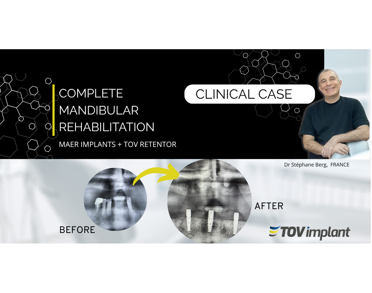 Complete Mandibular Rehabilitation with MAER Implants and TOV Implant Retentor System